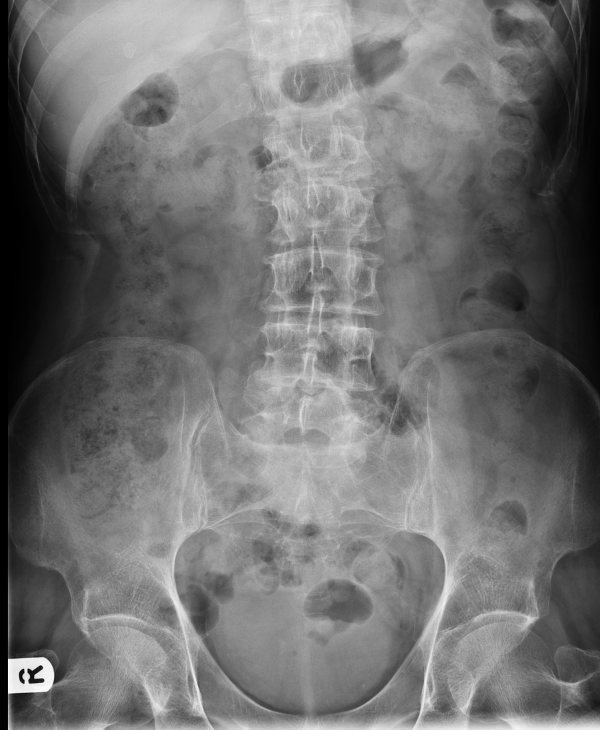 Radiografia normal d'abdomen. Hi apareix l'anatomia normal, a la part baixa podem observar la part superior de l'anell pelvià, al centre de la imatge hi veiem la columna lumbar. A la part alta d'aquesta radiografia es poden veure les últimes costelles. Al voltant d'aquestes estructures òssies hi han les diferents gradacions de blanc corresponents als diferents òrgans continguts a l'abdomen. També hi ha diferents bombolles d'aire corresponents a gas dins els intestins.