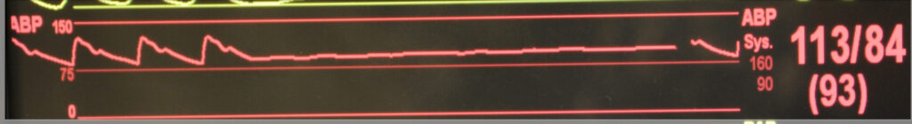 Traçat d'una corba de pressió arterial invasiva d'un monitor multiparamètric. En color vermell observem una línia que va oscil·lant repetint tres cops una corba típica, de l'esquerra cap a la dreta. Aquesta corba té un empit molt dret al seu inici, gairebé vertical, que descendeix de forma lenta des del cim de la pujada anterior. En aquest descens progressiu s'observa una osca aproximadament a la meitat d'aquesta baixada. Després de la tercera corba la línia es manté plana fins gairebé el final del traçat, en que hi ha la interrupció que indica que s'està registrant a partir d'aquest punt. Aquest traçat està circumscrit entre una línies rectes de referència. La inferior representa les 0 mmHg de pressió, la central, més estreta, correspon al 75 mmHg i la superior als 150 mmHg. El traçat de la corba es manté entre aquestes últimes línies. Al costat dret de la imatge se'ns mostren els valors de la última mesura, 113/84 a la part superior i (93) a la inferior.