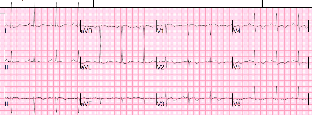 Electrocardiograma que mostra un patró A de Wellens. Es poden veure les ones T bifàsiques de V2 a V5.