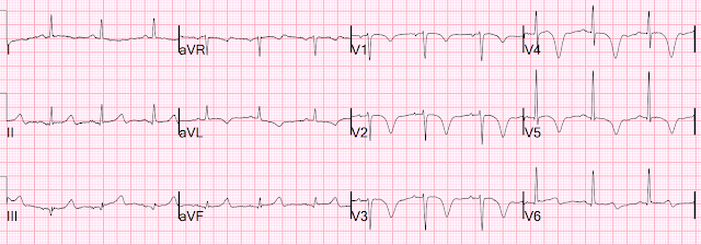 Electrocardiograma que mostra un patró B de Wellens. Es poden veure les ones T negatives de V2 a V5. No tant pronunciada a V1 i bifàsica a V6. També s'hi veu un infradesnivell de l'ST a cara lateral.