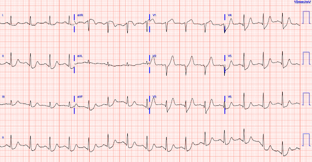 Electrocardiograma que mostra ones T de De Winter. Aquestes ones comencen una pujada còncava amb el punt J per sota la isoelèctrica. En aquest ECG es veuen especialment de V3 a V6, potser també a V2. A cara inferior també semblen iniciar-se per sota la isoelèctrica.