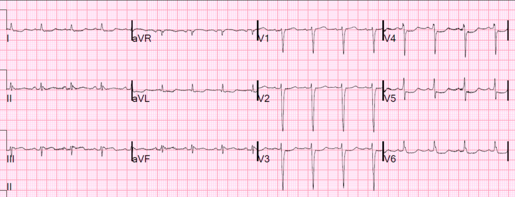 Electrocardiograma que mostra el patró d'Aslanger. En aquest ECG poden veure  elevació de l'ST a D.III i vR, petita però considerable en relació a la mida del QRS. També es veu a V5 i V6 un ST infradesnivellat que acaba amb una ona T mínima positiva.