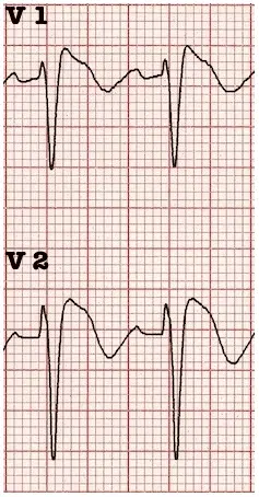 Complexos electrocardiogràfics típics d'un Brugada tipus I. La imatge mostra dos complexos QRS a derivacions V1 i V2. La ona T s'inicia just al final de la S. El punt J es troba força elevat. Des d'aquest punt J l'ST descendeix en un empit al voltant dels 45º fins a tornar la ona T negativa