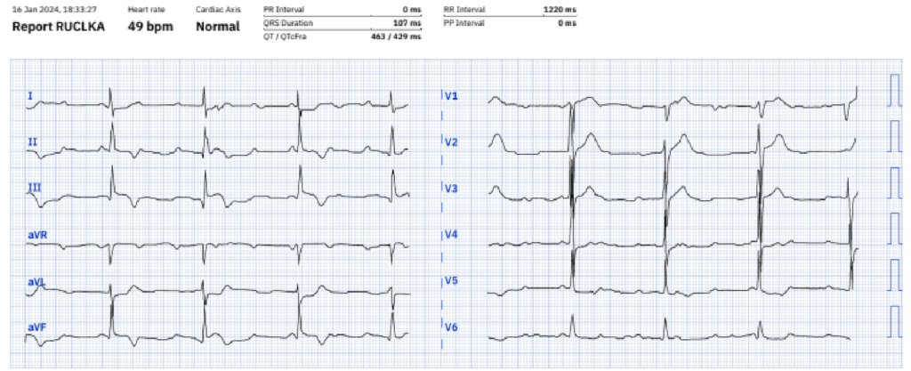 Electrocardiograma d'un pacient al cap de 15 minuts de ser reanimat d'una aturada cardíaca. Mostra una elevació de l'ST a cara inferior amb una inversió final de l'ona T. Imatge especular a cara lateral.