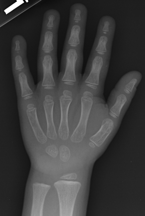 Radiografia front de mà d'una criatura de 4 anys