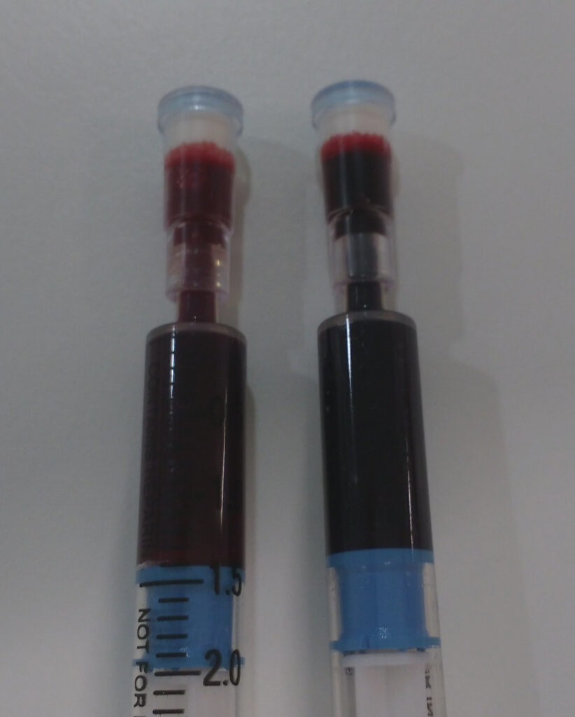 Xeringa amb sang arterial a l'esquerra, d'un color vermell més brillant, i una altra xeringa venosa, de color vermell més fosc