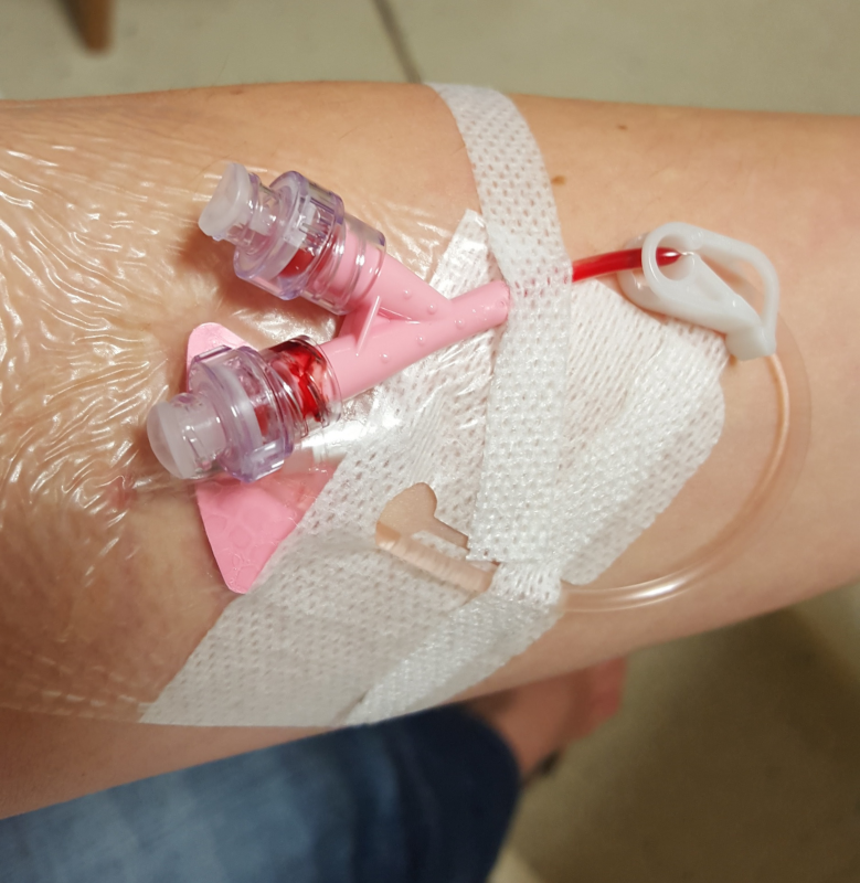 Catèter venós inserit a la sofraja d'un braç de pell blanca. El catèter, amb ales de color rosa, està cobert per l'apòsit transparent, en surt un tub de plàstic transparent que fa mig bucle retornant sobre el punt d'inserció. A uns centímetres de les ales hi veiem un clamp de color blanc que té la funció de pressionar el tub per a tancar el pas de líquid. Al final d'aquest tub hi ha una estructura de plàstic rosa que separa el tub en dos ports d'accés luer amb vàlvula antireflux. El tub esmentat es subjecta amb un parell de tires d'esparadrap prim, una prop del punt d'inserció i l'altra subjectant els ports d'infusió.