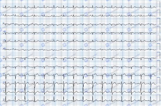 Digitalització d'un electrocardiograma