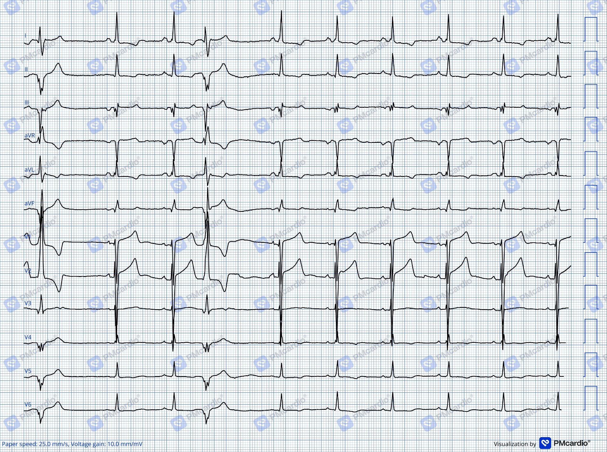Digitalització d'un electrocardiograma